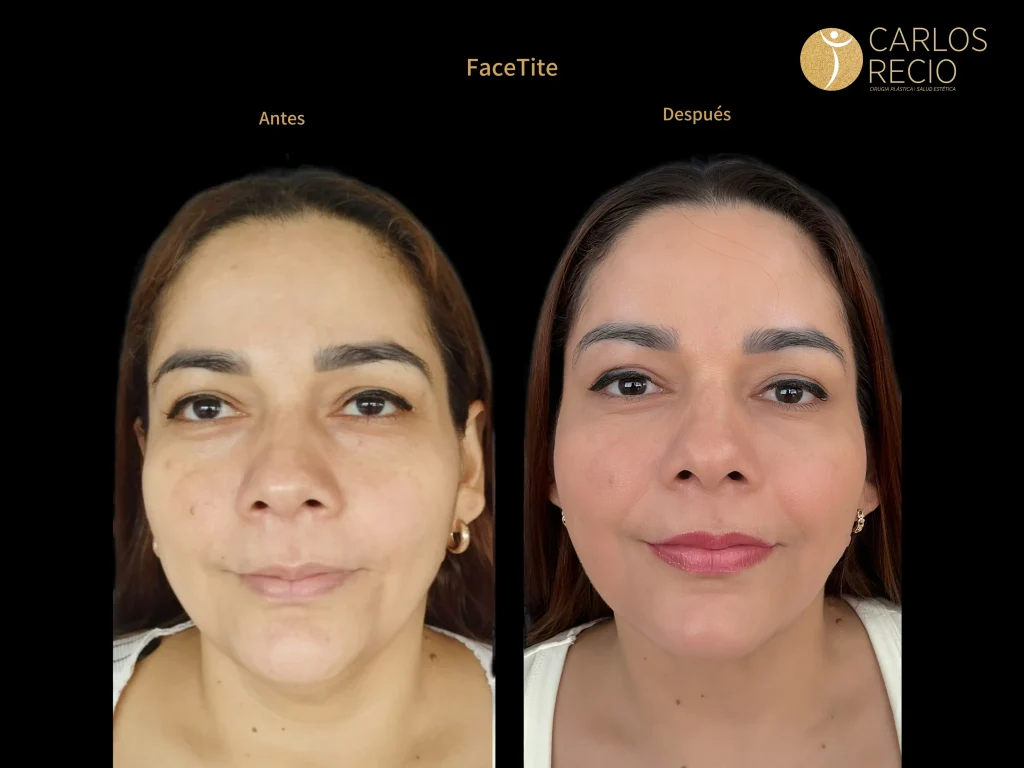 FaceTite: rejuvenecimiento facial sin bisturí FACETITE